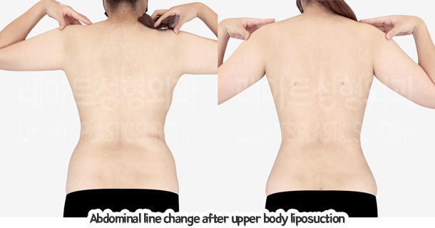 abdominal_liposuction_02_10_240105