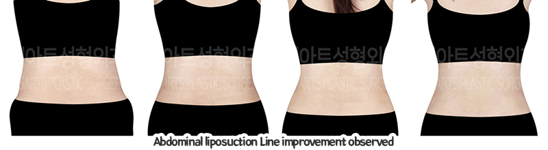 abdominal_liposuction_02_10_240110