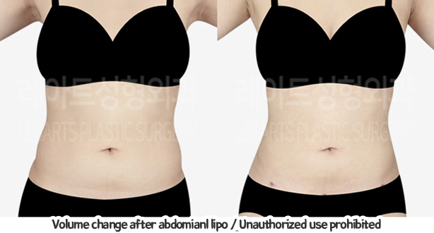 abdominal_liposuction_02_10_240119
