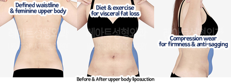abdominal_liposuction_02_11_240105