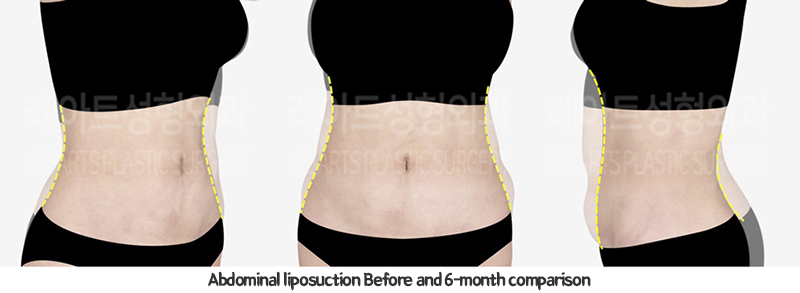 abdominal_liposuction_02_11_240110