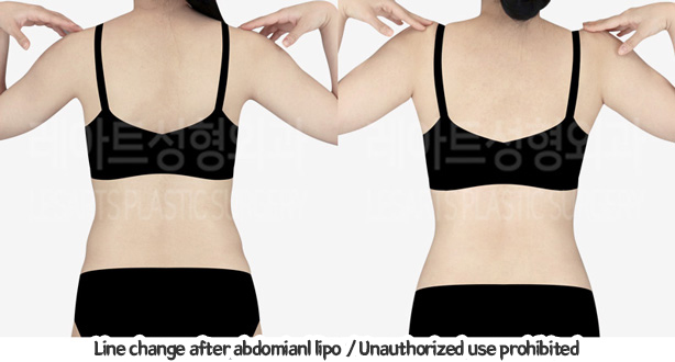 abdominal_liposuction_02_11_240119