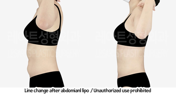 abdominal_liposuction_02_12_240119