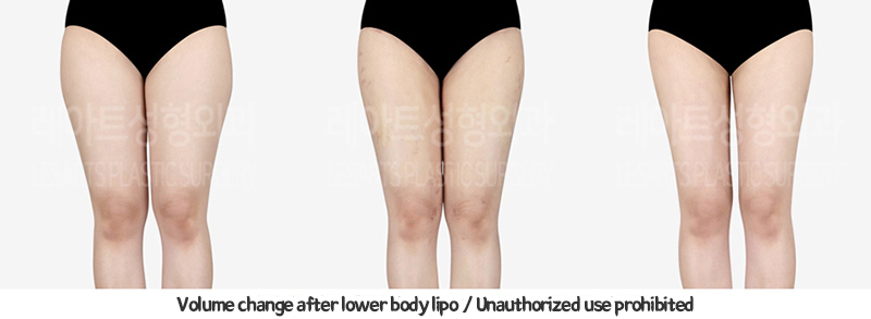abdominal_liposuction_02_13_240119
