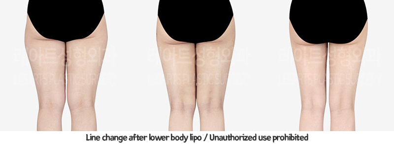 abdominal_liposuction_02_14_240119