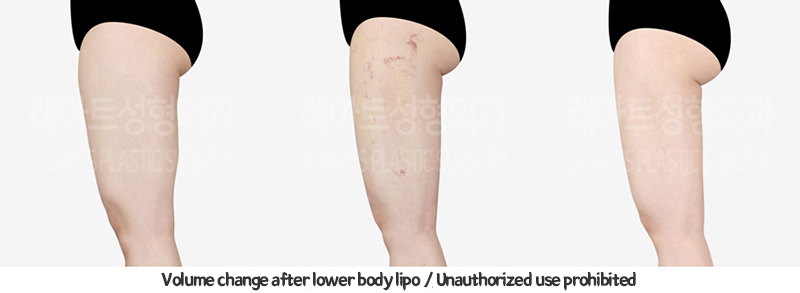 abdominal_liposuction_02_15_240119
