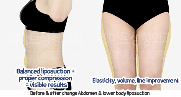 abdominal_liposuction_02_16_240119