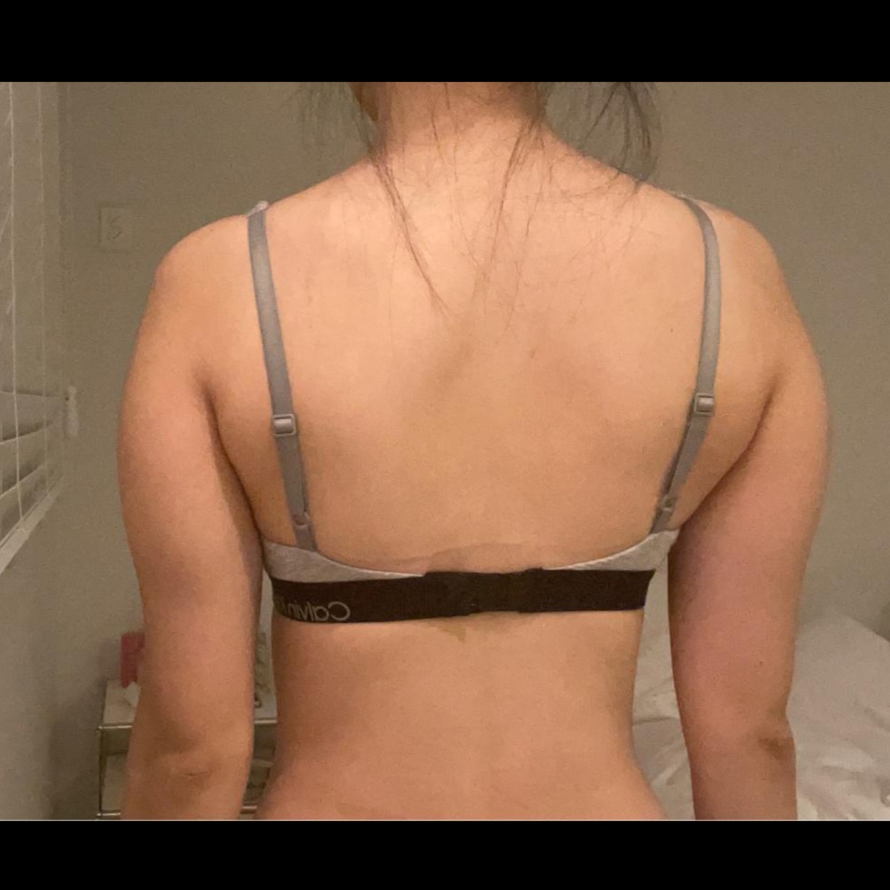 arm-liposuction-before2_BurrataCheese01