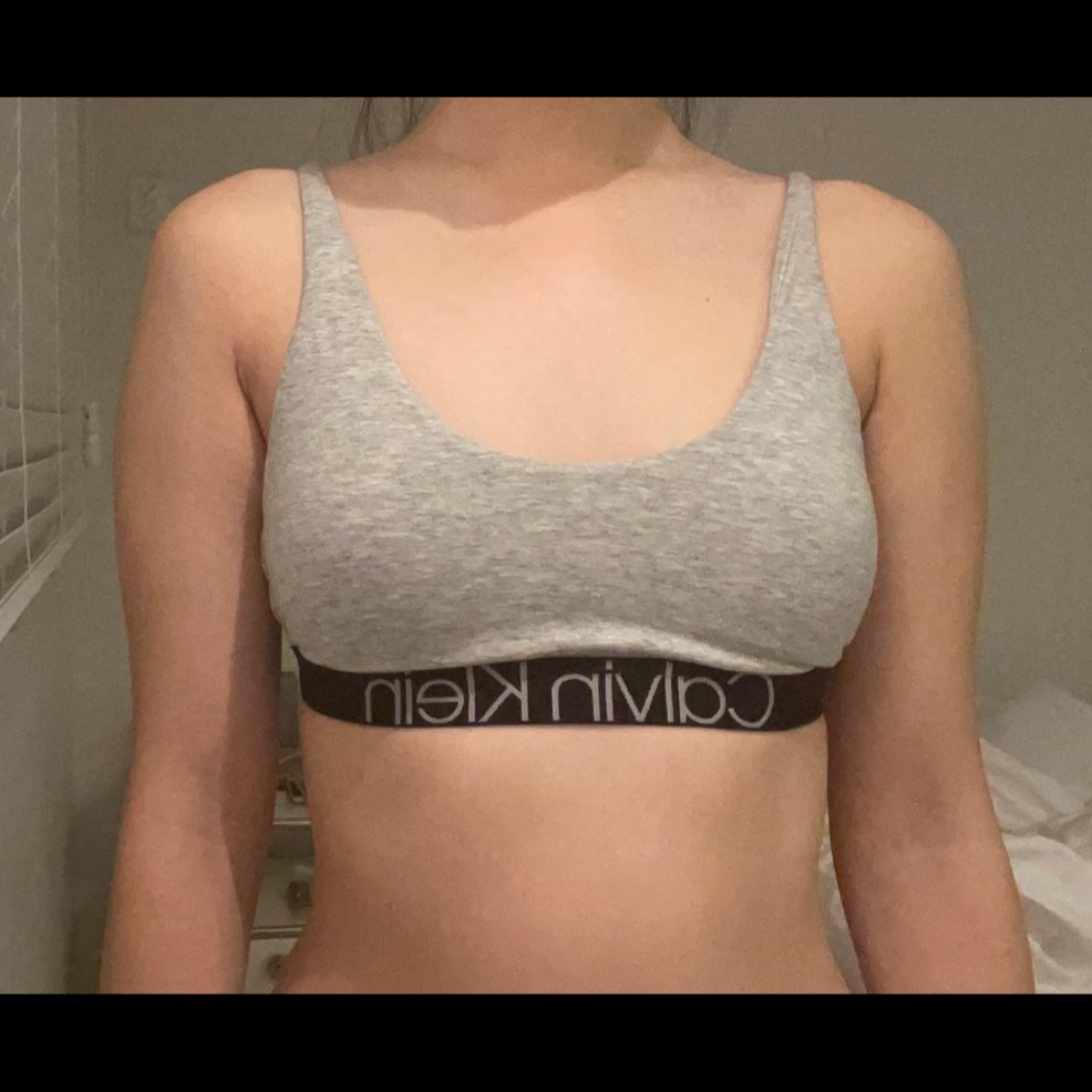 arm-liposuction-before_BurrataCheese01