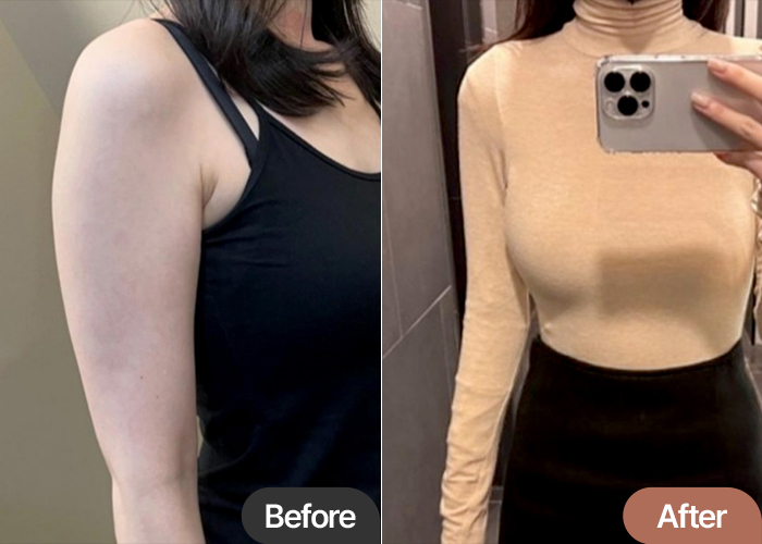 arm-liposuction-thumbnail-Bomingg-after
