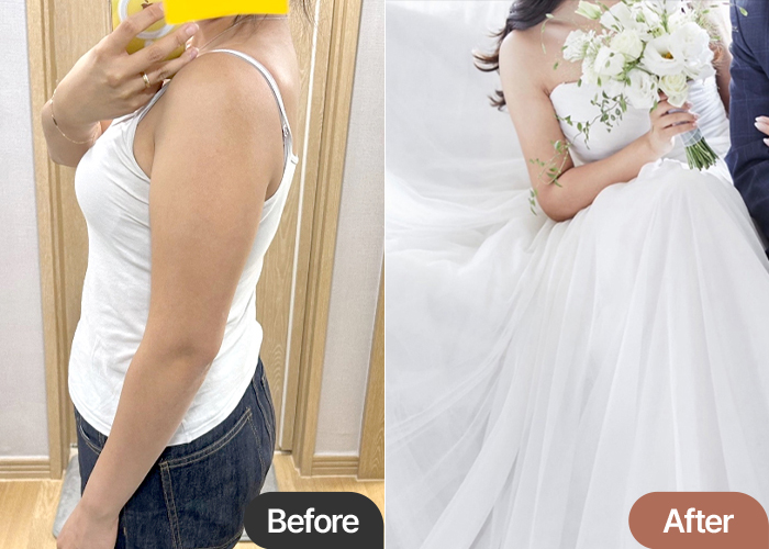 arm-liposuction-thumbnail-Chatansaraam