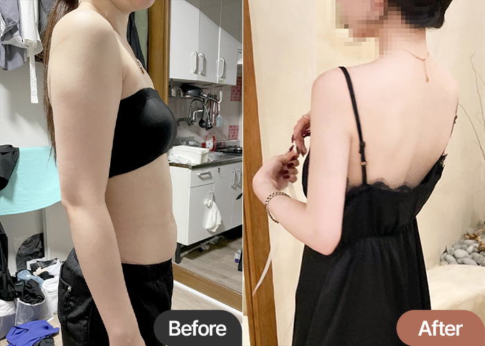 arm-liposuction-thumbnail-Dmsdbwl