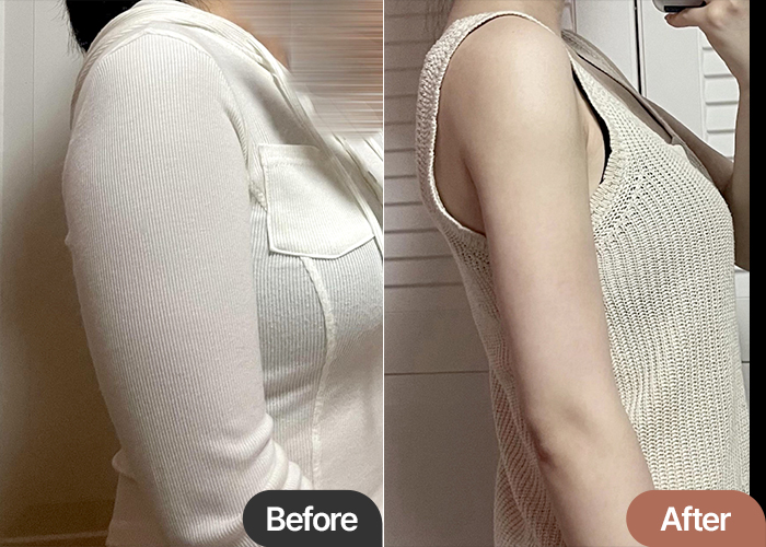 arm-liposuction-thumbnail-Gangju