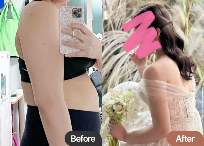 arm-liposuction-thumbnail-Ganuipalttuk-