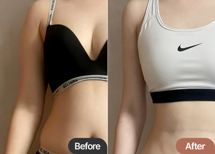 arm-liposuction-thumbnail-Iiiingiyaori