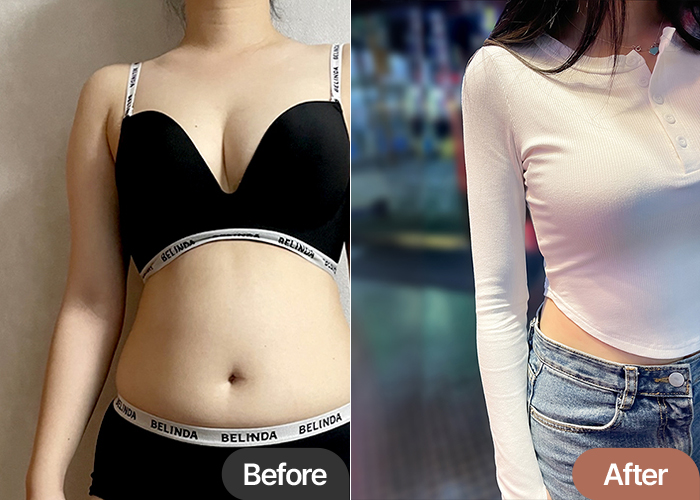 arm-liposuction-thumbnail-Iiiingiyaori_2