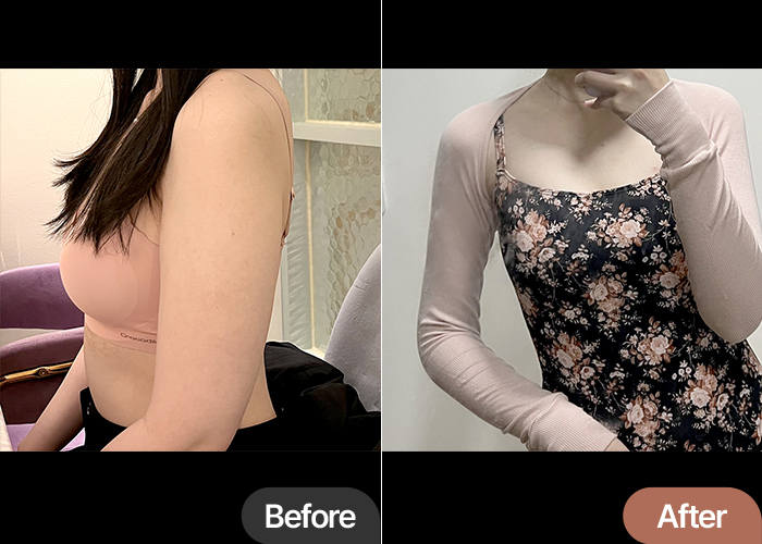 arm-liposuction-thumbnail-Iyor