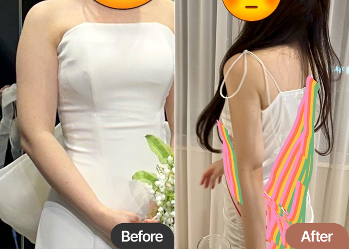 arm-liposuction-thumbnail-Jeonpokgun