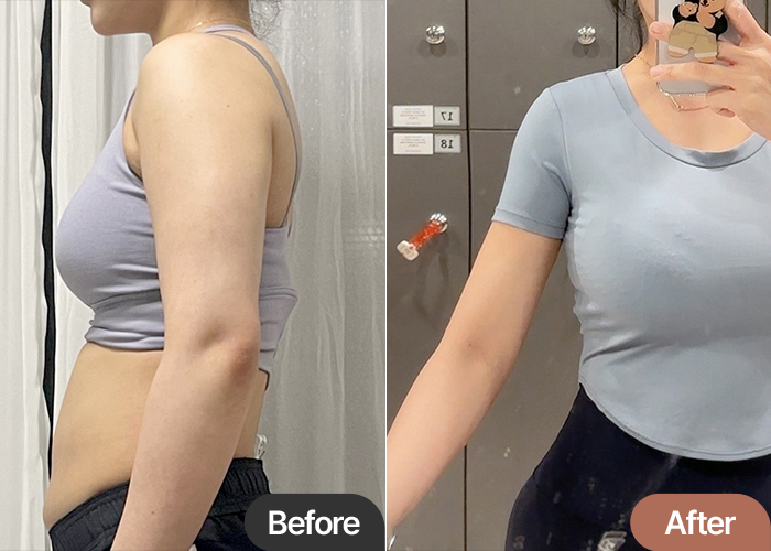 arm-liposuction-thumbnail-Kkossoong