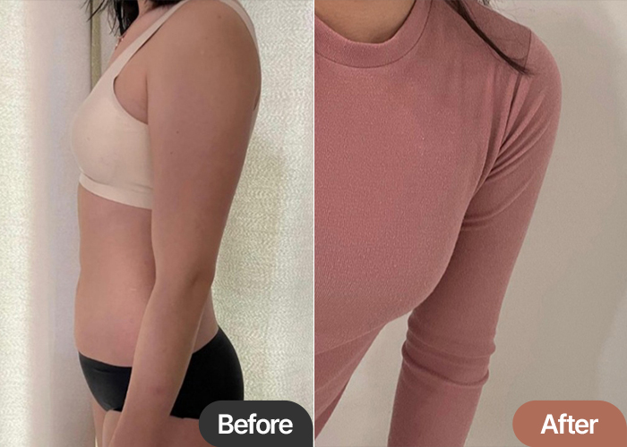 arm-liposuction-thumbnail-Larirarira