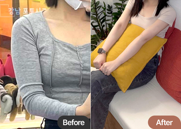 arm-liposuction-thumbnail-MeerkatSS