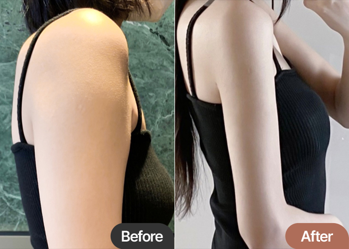 arm-liposuction-thumbnail-Mumyamya