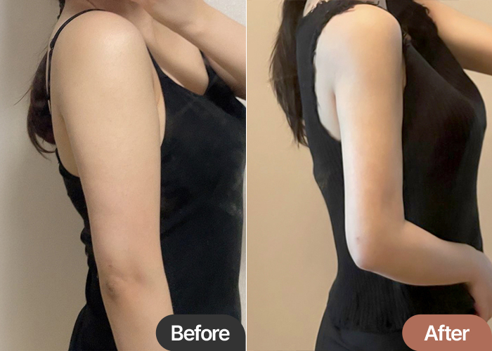 arm-liposuction-thumbnail-Ppangtteok