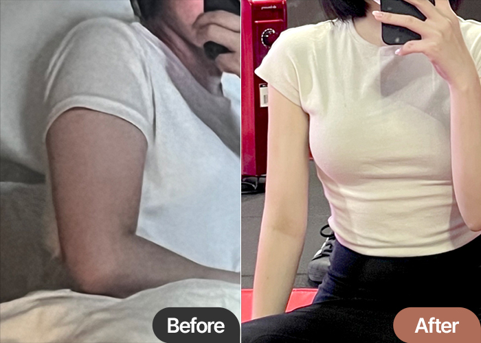 arm-liposuction-thumbnail-Ttuhyeoi