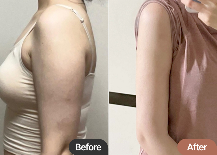 Arm Liposuction Results | Every friend I meet asks how I’ve become so slim