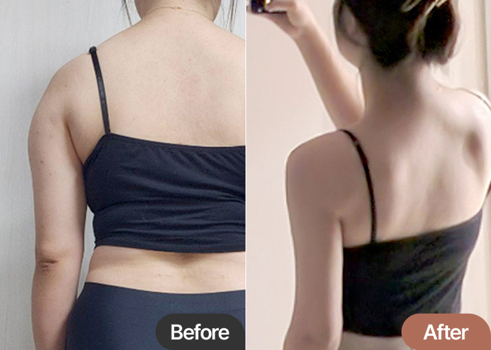 arm-liposuction-thumbnail-doomzzi