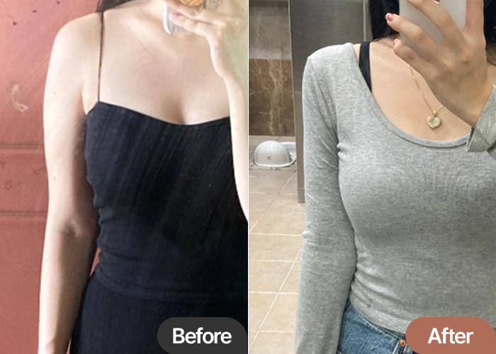 arm-liposuction-thumbnail-hotyu