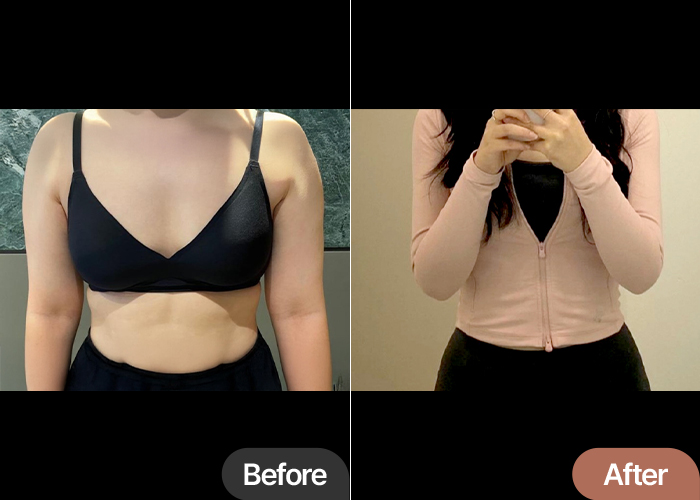 arm-liposuction-thumbnail-kkungjakjjat
