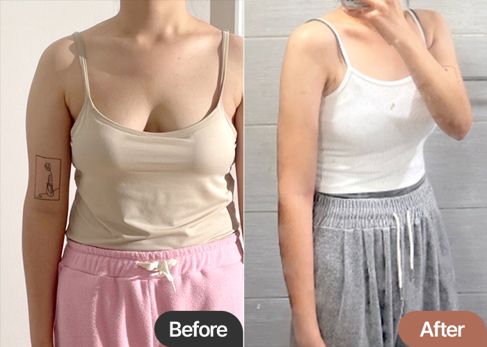 arm-liposuction-thumbnail-oejaeun