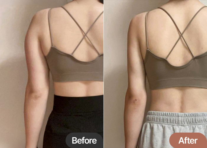 arm-liposuction-thumbnail-qlqll