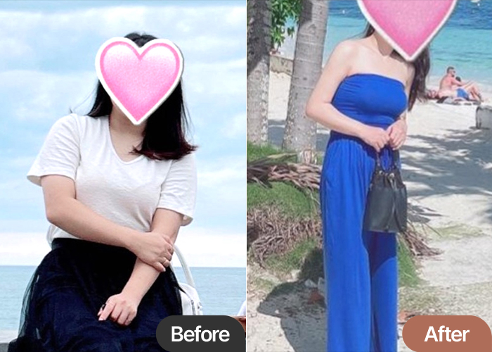 arm-liposuction-thumbnail-selfie-PalttukComplex