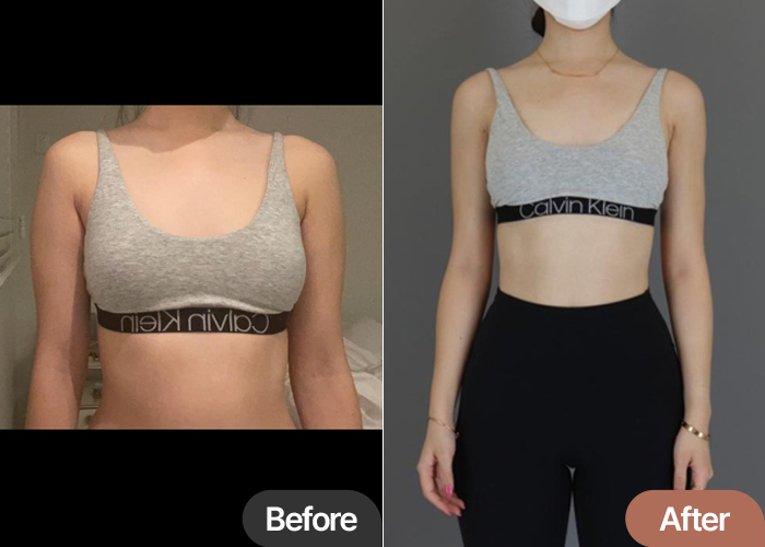 arm-liposuction-thumbnail_Burrata2