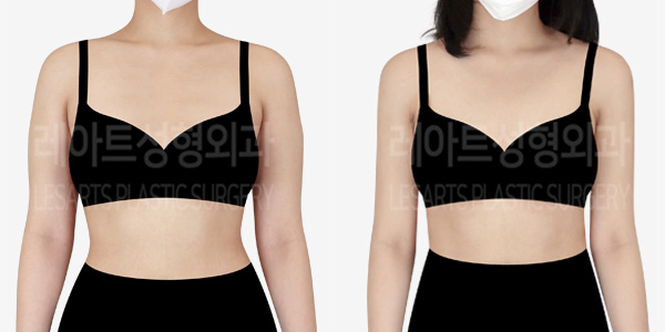 arm_liposuction_01_thumbnail_231226