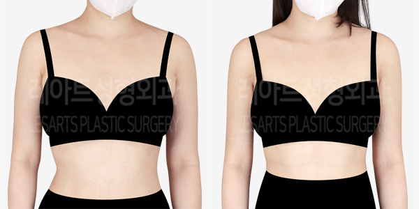 arm_liposuction_01_thumbnail_240105