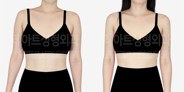 arm_liposuction_01_thumbnail_240111