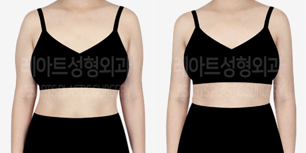 arm_liposuction_01_thumbnail_240117