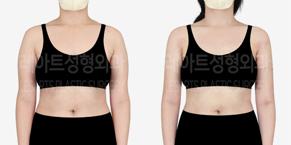 arm_liposuction_01_thumbnail_240129