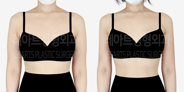 arm_liposuction_01_thumbnail_240208