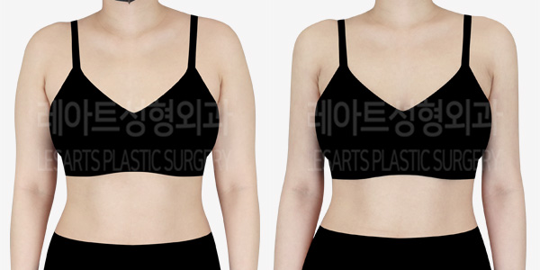 arm_liposuction_01_thumbnail_240219_2