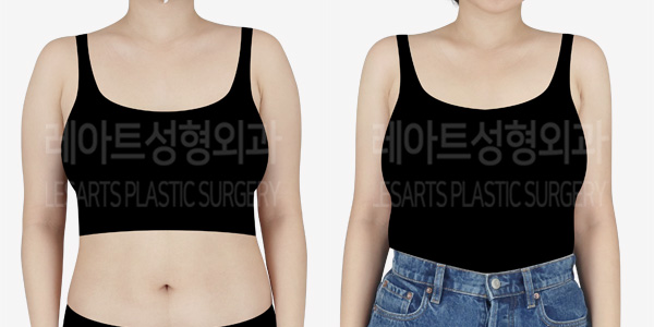 arm_liposuction_01_thumbnail_240223