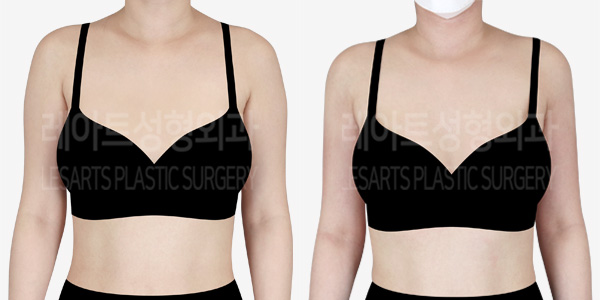 arm_liposuction_01_thumbnail_240229