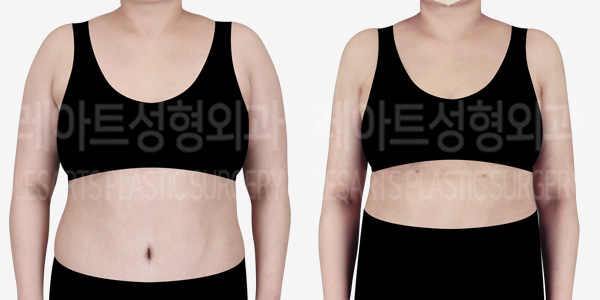 arm_liposuction_01_thumbnail_240315
