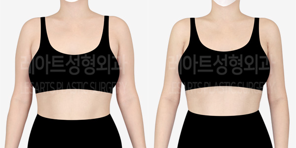 arm_liposuction_01_thumbnail_240326