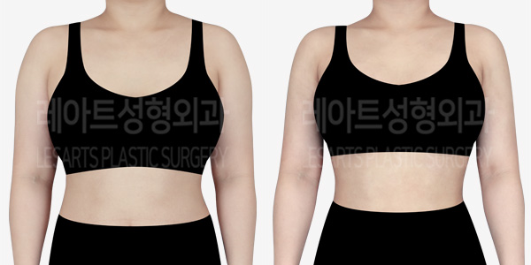 arm_liposuction_01_thumbnail_240401