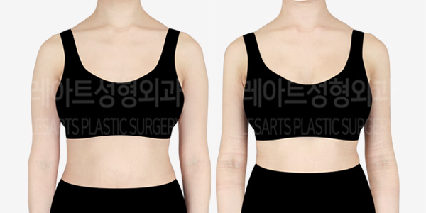 arm_liposuction_01_thumbnail_240422