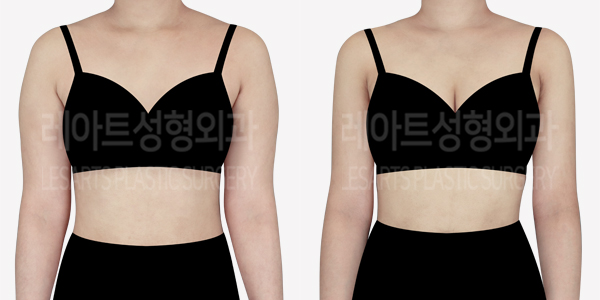 arm_liposuction_01_thumbnail_240527